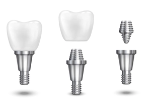 Implante dental Implante dental